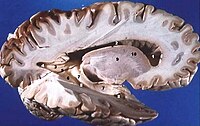 ヒト脳の断面を側面から見た図