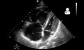 File:UOTW 65 - Ultrasound of the Week 1.webm