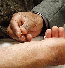 Acupuncture involves insertion of needles in the body. Acupuncture1-1.jpg