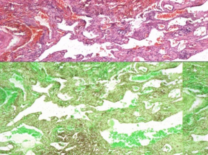 Белодробна биопсия, показваща инфилтрация на лимфната тъкан.png