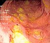Imatge endoscòpica de colitis de Crohn