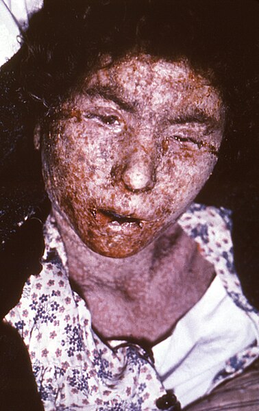 파일:Female smallpox patient -- late-stage confluent maculopapular scarring.jpg