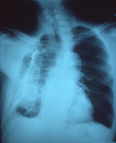 Fibrothorax-torakx-ray.jpg