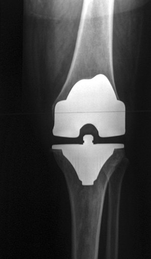 צילום רנטגן של מפרק ברך שמאל לאחר החלפת מפרק מלאה. המפרק המלאכותי נראה בתמונה בלבן..
