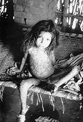 A child showing rash due to ordinary-type smallpox (variola major) Smallpox child.jpg