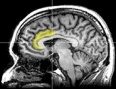 The biomechanics of cognitive dissonance: MRI evidence indicates that the greater the psychological conflict signalled by the anterior cingulate cortex, the greater the magnitude of the cognitive dissonance experienced by the person. MRI anterior cingulate.png