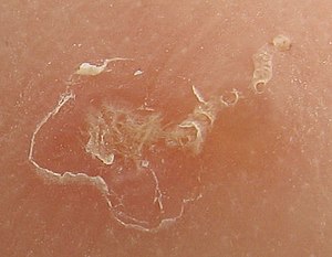Close-up photo of a scabies burrow. The large ...