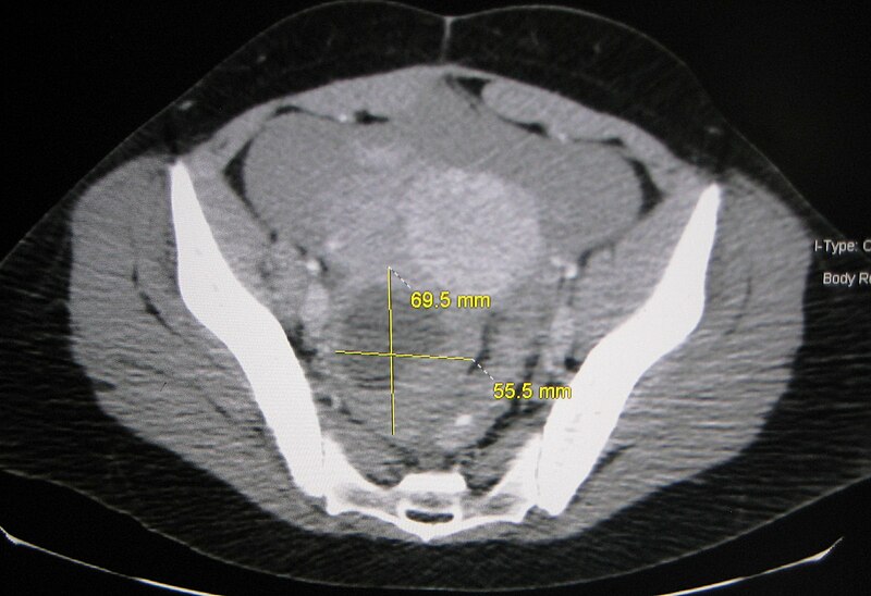 Vaginal discharge/lower abdomen.