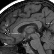 MRI of corpus callosum and its named parts Corpuis callosum.png
