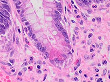 Paneth cell (pictured) or gastric metaplasia (only applies in the left colon and rectum)