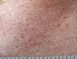 Pruritic rash COVID.jpg