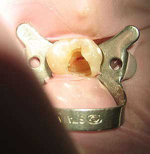 Tooth #13, the upper left second premolar, aft...