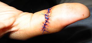 8 nonabsorbable sutures in a person's left thumb.