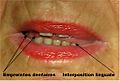Fig. 3. Vidéographie numérique chez le patient adulte : empreintes dentaires et interposition linguale lors de la phonétique.