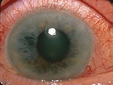 http://upload.wikimedia.org/wikipedia/commons/thumb/1/13/Acute_Angle_Closure-glaucoma.jpg/230px-Acute_Angle_Closure-glaucoma.jpg
