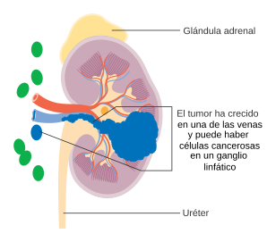Cáncer de riñón en etapa 3