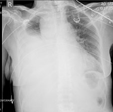 تصوير صدري بالأشعة السينية يُظهر تدمي صدري كبير في الجانب الأيمن