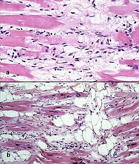 Arrhythmogenic right ventricular cardiomyopathy - histology.jpg