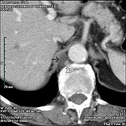 가슴림프관(화살표)는 홀정맥(구부러진 화살표)과 인접해 있다. 일반적으로 CT에서는 보이지 않는다. 이 사진은 위장관 기질 종양의 추적 관찰을 위해 CT를 받은 83세 남성의 사진이다.