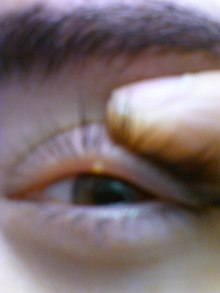 Stye on the upper eyelid