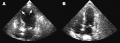 (A) Echocardiogram showing dilatation of the left ventricle in the acute phase (B) Resolution of left ventricular function on repeat echocardiogram six days later