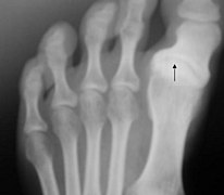 Radiographie d'un cas d'hallux varus.