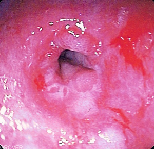 Endoscopic image of peptic stricture showing n...