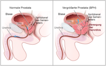 Schematische Darstellung der benignen Prostatahyperplasie