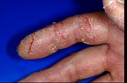 This individual has hand eczema, which causes much harm to the skin. Handekzem hyperkeratotisch-rhagadiform.jpg