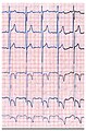 Das EKG eines Morbus-Fabry-Patienten zeigt eine linksventrikuläre Hypertrophie mit erhöhtem Sokolow-Lyon-Index, reduzierter ST-Strecke und negativen T-Wellen in den linken EKG-Ableitungen.
