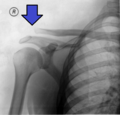 Miniatura para Dislocación acromioclavicular