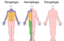 Un esempio di aree interessate che rappresentano le differenze tra paraplegia (a sinistra), emiplegia (al centro) e quadriplegia (a destra).