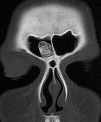 CT остеома у чеоном синусу