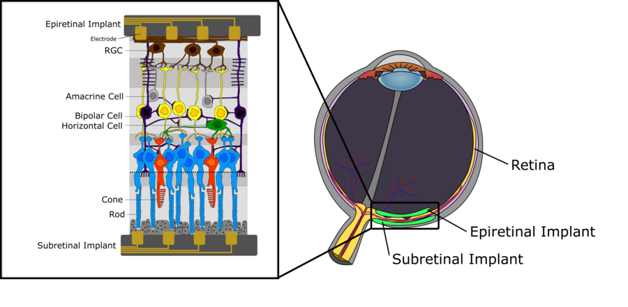 Retina Implantat im Auge