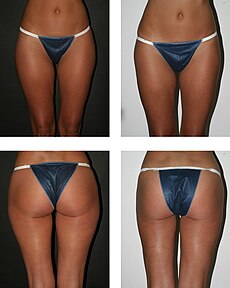 liposuction wikipedia intervention thigh outer dr