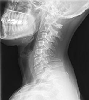 Cervical spine in X-ray, lateral view