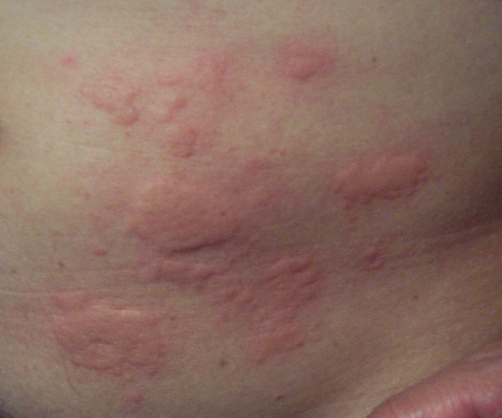 The image “http://upload.wikimedia.org/wikipedia/commons/thumb/1/19/Rash.jpg/720px-Rash.jpg” cannot be displayed, because it contains errors.
