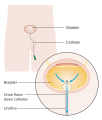 Urinarni kateter kod muškarca kome je uklonjena prostata