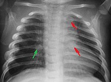 Rib fractures in an infant secondary to child abuse Fractured ribs.jpg