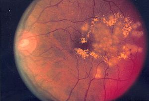 Fundus photo showing focal laser surgery for d...