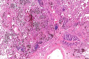 Pulmonary haemorrhage - low mag.jpg