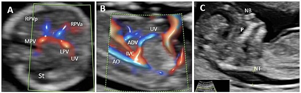 Agenesis of ductus venosus (ADV) in a first trimester case with umbilical vein drainage into inferior vena cava (IVC) and increased nuchal translucency. (A): Transverse plane of the FT fetal abdomen, with high-definition directional power Doppler applied. An "H"-shaped variant of the intrahepatic portal veins connection is identified; (B): high-definition directional power Doppler in the sagittal plane of the fetal abdomen (same case) showing ADV with umbilical vein drainage into the inferior vena cava; (C): mid-sagittal view of the fetal face with the measurement of the thickened NT. MPV main portal vein, St stomach, LPV left portal vein, UV umbilical vein, RPVa anterior branch of right portal vein, RPVp posterior branch of right portal vein, Ao aorta, IVC inferior vena cava, ADV ductus venosus agenesis, P palate, NB nasal bone, NT nuchal translucency. Agenesis of ductus venosus human.jpg