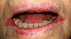 التهاب الشفة الزاوي ثنائي الجانب لدى شخص كبير السن (كهل) لديه سن مستعار مع فقر الدم الناجم عن نقص الحديد إلى جانب جفاف الفم.