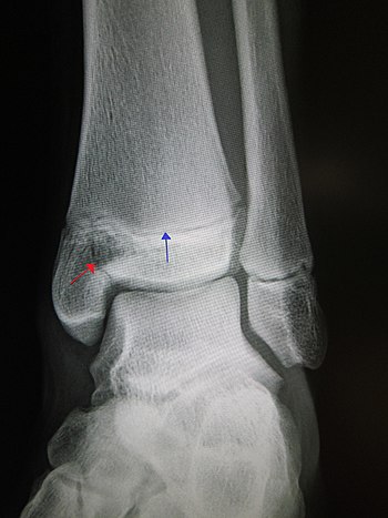 English: An Xray of the left ankle showing a S...
