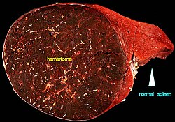 ورم عابي (هامارتوما) ضخم في الطحال. الورم العابي هو جسم دائري داكن على اليسار ويسود ويغلب على الصورة. الصورة توضح مقطع عرضي، يظهر نمو الورم بقطر 9 سم بينما يكون قطر الطحال ككل 11 سم.[1]