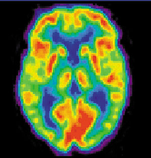 Positron emission tomography image of a human ...