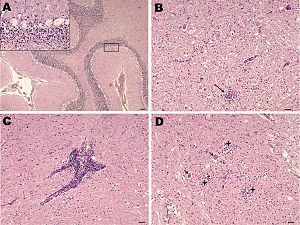 Nonsuppurative encephalitis in goat affected by louping ill.jpg