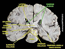 Судинне сплетення (Choroid plexus) на анатомічній диссекції мозку