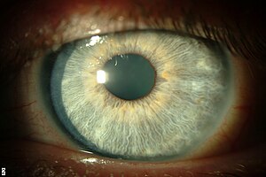 Thygeson's keratitis left cornea after cyclosporin A treatment.jpg
