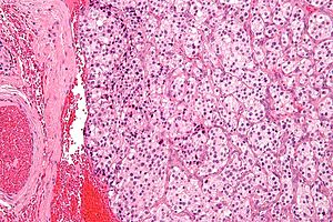 Carotid body tumour 2 intermed mag.jpg